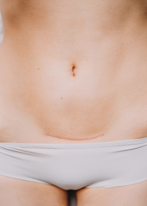 Postpartum Healing Tips After a Cesarean Birth